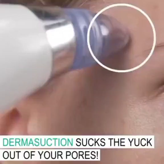Derma Suction Blackhead Remover – Cell Operated